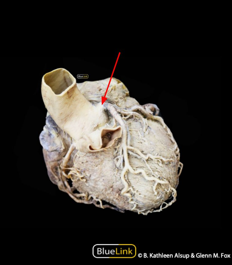 Anatomy practical photograph with an arrow indicating the left coronary artery
